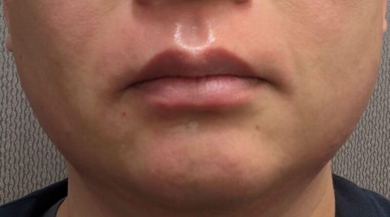 2026年4月の脱毛処理直後。赤みが残っている。