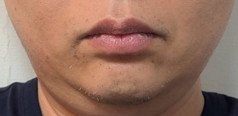 2026年4月の数日放置したヒゲの状況